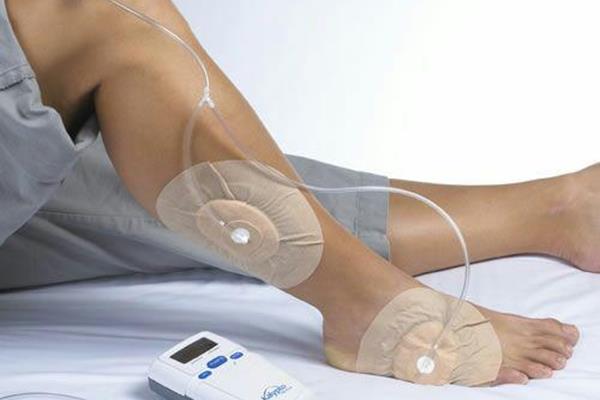 درمان زخم با فشار منفی یا وکیوم تراپی  چه تاثیری در درمان زخم پای دیابتی دارد؟